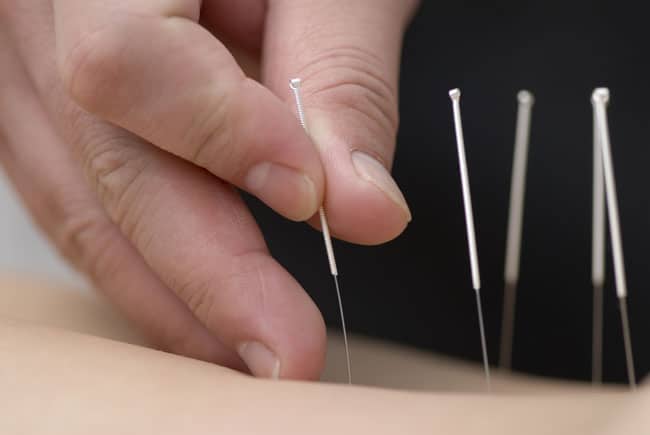 se soigner avec l'acupuncture