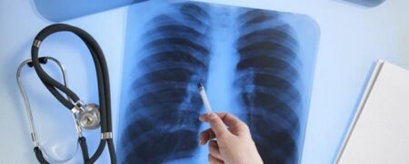 Cancer du poumon une application ameliore le suivi des malades