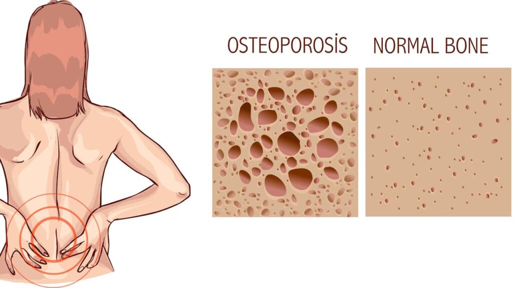 osteoporose