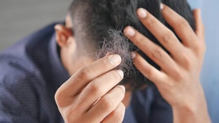 perte-de-cheveux-homme (1)